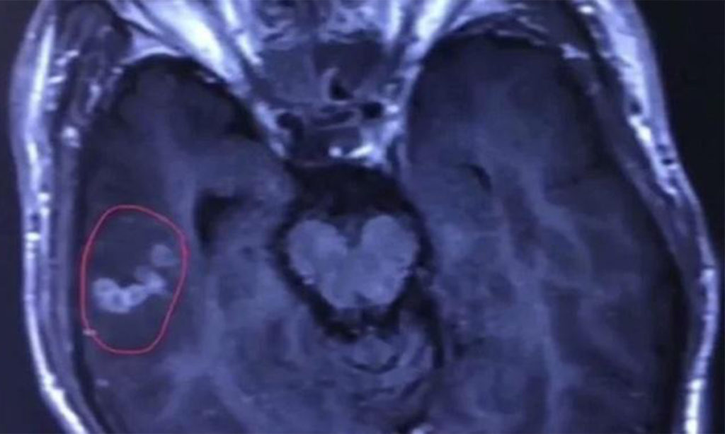 Seekor Cacing Ditemukan di Otak Pria Ini, Faktanya Bikin Syok