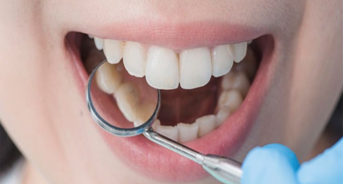 7 Cara Alami Untuk Menghilangkan Plak dan Karang Gigi