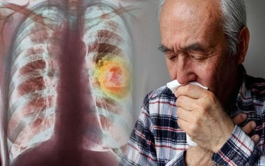 Penyakit Yang Ditimbulkan Dari Polusi Udara? Pembunuh Perlahan