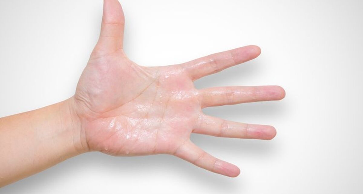 9 Penyebab Telapak Tangan Berkeringat, Pahami Cara Mengatasinya