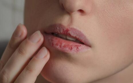11 Penyebab Bibir Kering dan Cara Mengatasinya yang Tepat