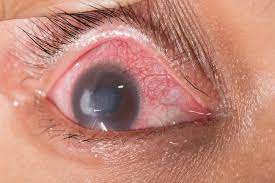 Walaupun jarang, tetapi pemakaian obat tetes mata yang berlebihan bisa merusak kornea.