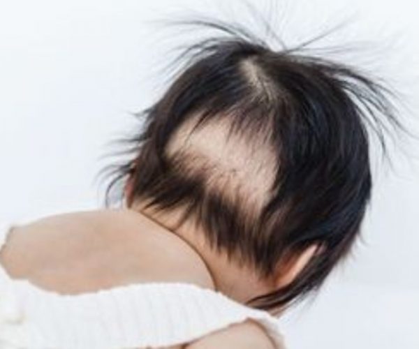 Pemicu Rambut Bayi Botak di Belakang