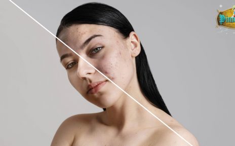 Treatment Skincare untuk Atasi Acne Scars, Sudah Tahu