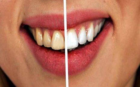 6 Bahan Alami Ini Ampuh Buat Gigi Lebih Putih